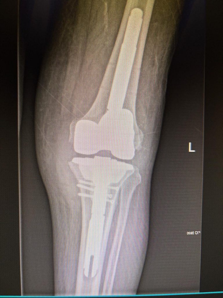 mein neues Knie seit 18.12.25