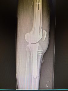 mein neues Knie seit 18.12.25